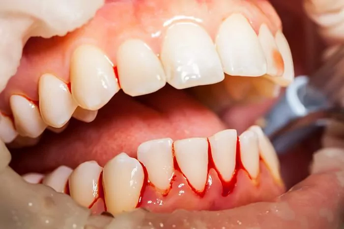 Ви ігноруєте цей симптом щоранку - і ризикуєте залишитися без зубів