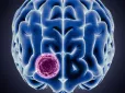 Не пропустіть! ТОП-7 перших симптомів пухлини головного мозку